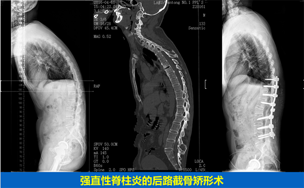 脊柱畸形的手术治疗