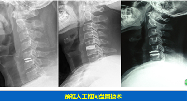 颈椎疾病的手术治疗