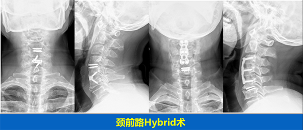 颈椎疾病的手术治疗