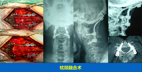 颈椎疾病的手术治疗