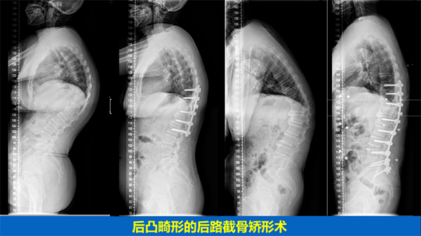 脊柱畸形的手术治疗