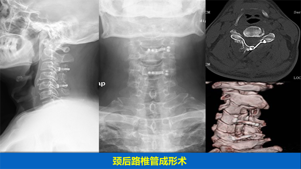 颈椎疾病的手术治疗